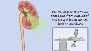 Extracorporeal Shock Wave Lithotripsy (ESWL)