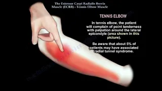 Tennis Elbow Clinical and Anatomical Considerations. The tennis elbow muscle.