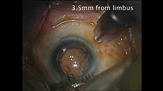 Intravitreal injection bevacizumab in a pseudophakic patient with diabetic macular oedema