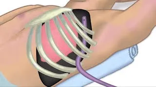 "Chest Tube Placement" by Chris Weldon for OPENPediatrics