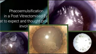 Phacoemulsification in a Post Vitrectomised eye -  what to expect and thought processes involved.