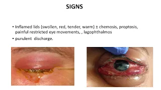 orbital Cellulitis 4th year MBBS lecture by Prof.Dr.H.A.Khaqan