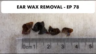 3.5CM EAR WAX REMOVED - EP 78