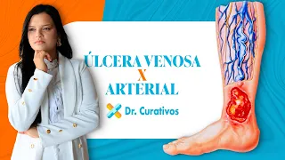 Úlceras venosas vs. Arteriais - Conheça a diferença!