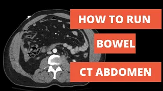 How to read a CT - Approach to Running Bowel