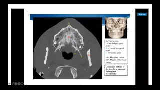 CT facial bones in trauma