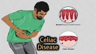 5 Signs and Symptoms of Celiac Disease You Should Not Ignore