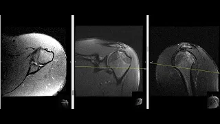 23 year old male with shoulder pain