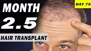 FUE Hair Transplant 2,5 MONTHS (post op) Istanbul, Turkey