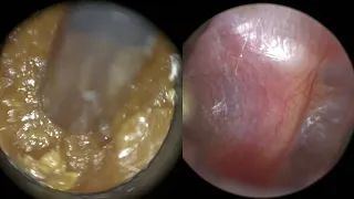 158 - Totally Blocked Ear Wax Removal using the WAXscope®️