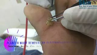 Wart Removal | Plantar Wart Removal on the Bottom of a Foot by Electrocautery | Skinaa Clinic,Jaipur