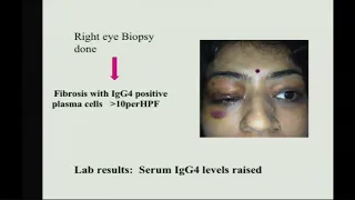 AIOC2018 - FP452 - Orbit & Oculoplasty - I - Topic - Lesions of the Lacrimal Gland: