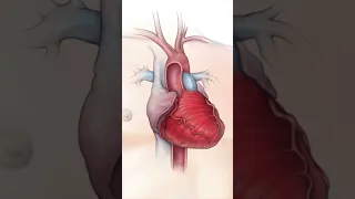 PreOp® Coronary Angioplasty with Stent Placement - Patient Education #shorts