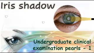 IRIS SHADOW | Undergraduate Clinical Examination Pearls 1