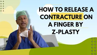 Contracture release of finger by Z-Plasty