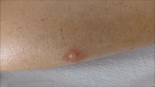 blisters from mosquito bites , before and after treatment
