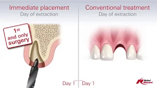 Immediate Placement vs Conventional Treatment (Dental Implants)