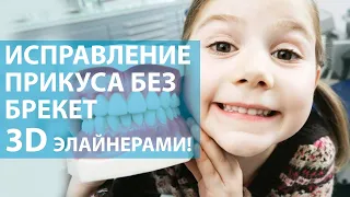 Исправление прикуса у детей и подростков без брекетов 3D элайнерами