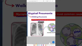 Pneumonia in a nutshell