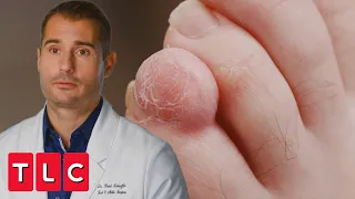 Removing a Patient's "Alien Toe" | My Feet Are Killing Me
