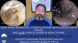 DEAD SKIN & EAR WAX REMOVAL - EP 324