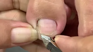 deep leg skin cutting technique#264