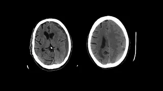 Imaging in Head trauma