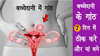 प्रेग्नेंट न होने का बड़ा कारण है बच्चेदानी में गांठ और रसोली | bachedani gaanth endometrios fibroid