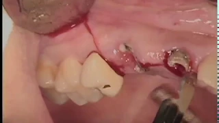 Piezoelectric removal of impacted canine and immediate implant placement