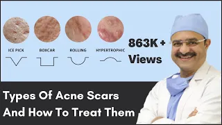 Types Of Acne Scars And How To Treat Them | ClearSkin, Pune | (In HINDI)