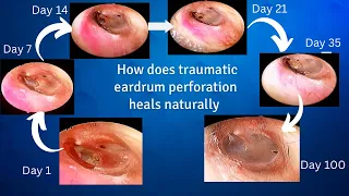 Natural healing of traumatic eardrum perforation - weekly follow up videos