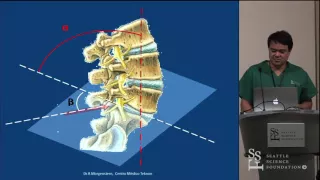 Full Endoscopic Lumbar Surgery: Indications, Techniques, & Avoiding Complications - James Yue, MD