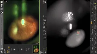 Копия виде "Navigated peripheral retinopexy (Navilas) Навигационная отграничительная лазеркоагуляция