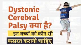 Dystonic/dyskinetic cerebral palsy! treatment of dystonic cp! symptoms of dystonic cp