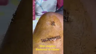 Skin stapler Removal at Home after surgery by Dr J K dada | STAPLER SELF CARE GUIDE