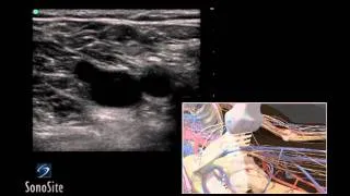 How To: Deep Vein Thrombosis Ultrasound Exam 3D Video