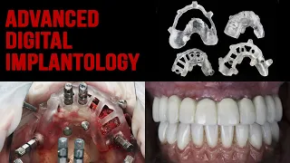All on Four - lower and upper jaw - Multicomponent templateIntra