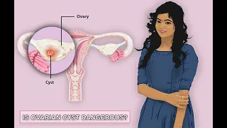 Ovarian Cyst : All You Need to Know About Types and Risk Factors @healthypanda.official