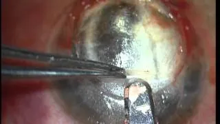 Tucked In Lamellar Keratoplasty TILK   Soosan Jacob