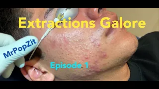Acne Extractions Galore part 1.Ingrown hairs, blackheads, whiteheads.Loop extractor,Q-tips.MrPopZit