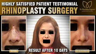 Highly Satisfied Patient Review | Rhinoplasty | Results after 10 Days
