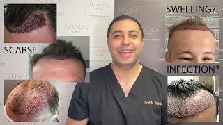 What To Expect After A Hair Transplant? | After Care