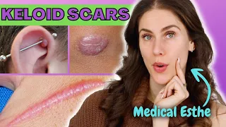 How To Treat Keloid Scars At Home - Is It Possible? Why Do Keloid Scars Happen?