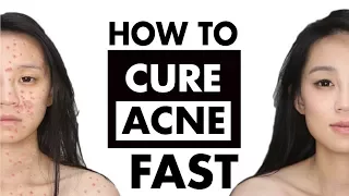 How To Get Rid of Acne | Best Spot Treatment | How To Use Benzoyl Peroxide | Prevent Acne 2021