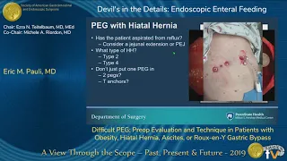 Difficult PEG: Preop Evaluation and Technique in Patients with...