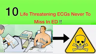 10 Life-threatening ECGs Never To Miss In ED: Deadly ECG Patterns-Part 1