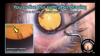 CataractCoach 1385: Cataract Quiz: you notice this after draping