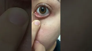 Mucus fishing in my eye ball after removing eye makeup