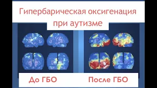 Камера гипербарической оксигенации [ГБО] лечение аутизма