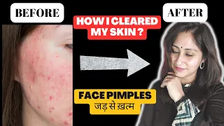 How I Got Clear Skin Naturally ? Face Pimples Treatment At Home | Pimples Kese Hataye